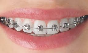 braces